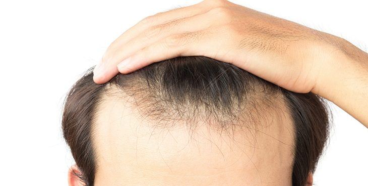 إغلاق مركز شهير لزراعة الشعر و إحالة ملفه إلى النائب العام